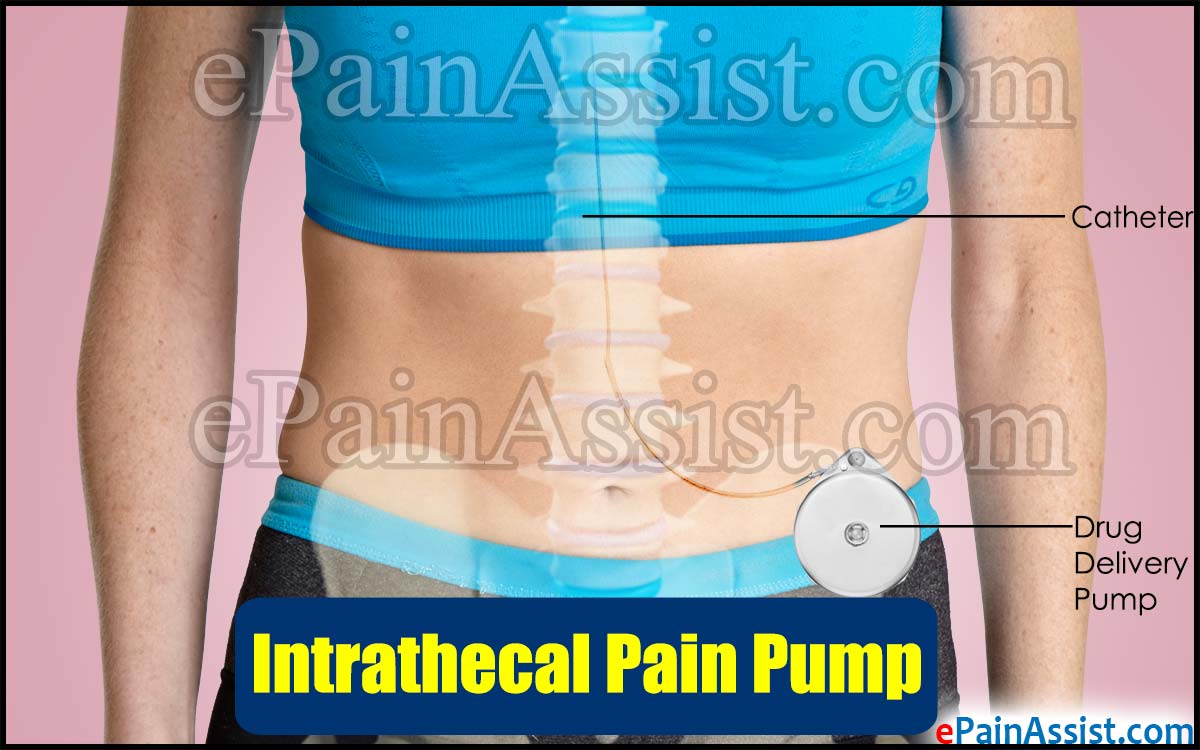 Intrathecal Pain Pump Intrathecal Pain Pump