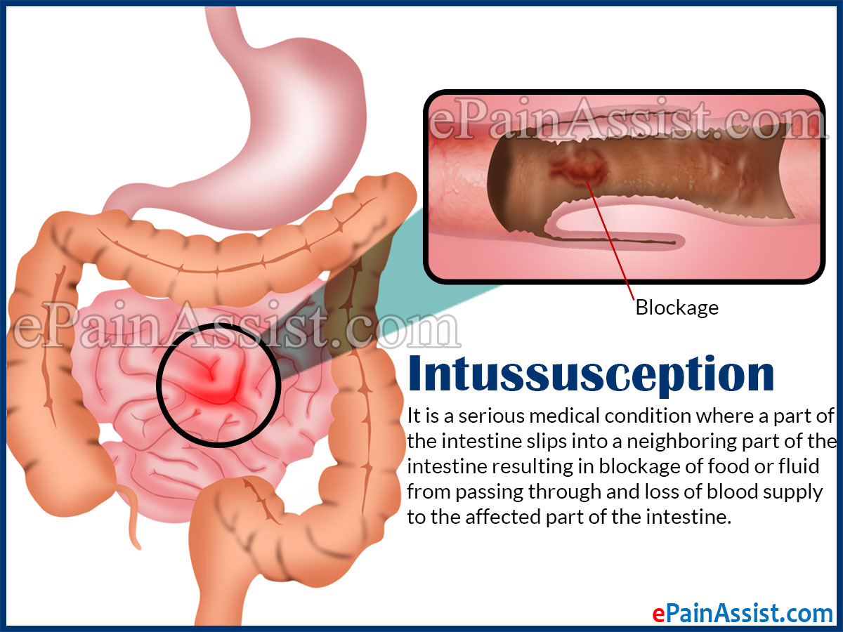 Intussusception: Treatment, Causes, Symptoms, Risk Factors, Tests Intussusception: Treatment, Causes, Symptoms, Risk Factors, Tests