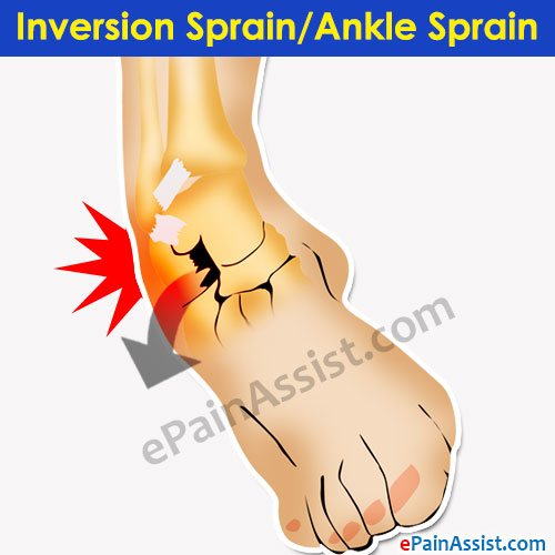 Inversion Sprain/Ankle Sprain Inversion Sprain/Ankle Sprain