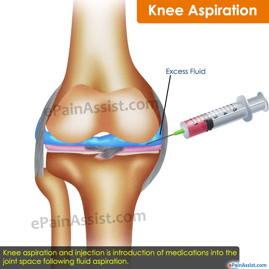 What is the most effective treatment for fluid in the knee joint?