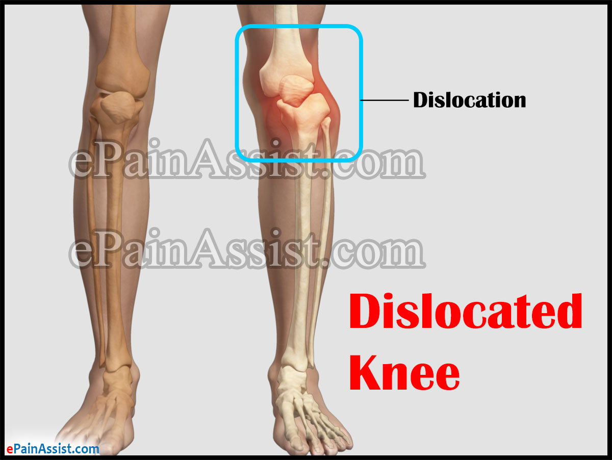 Knee Dislocation or Dislocated Knee Knee Dislocation or Dislocated Knee