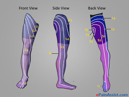 Causes of Entire Leg Pain or Sciatica Pain