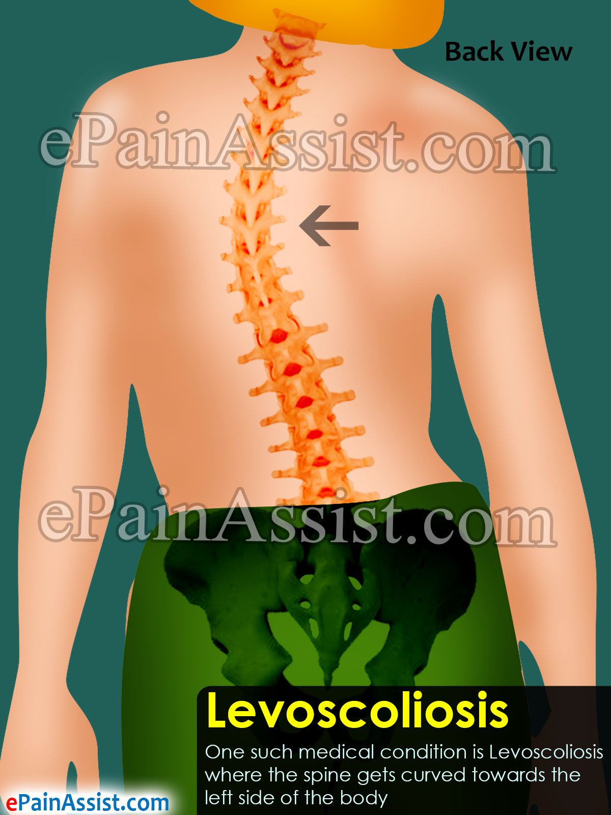 Levoscoliosis|Treatment|Braces|Physical Therapy|Surgery|Exercises Levoscoliosis|Treatment|Braces|Physical Therapy|Surgery|Exercises