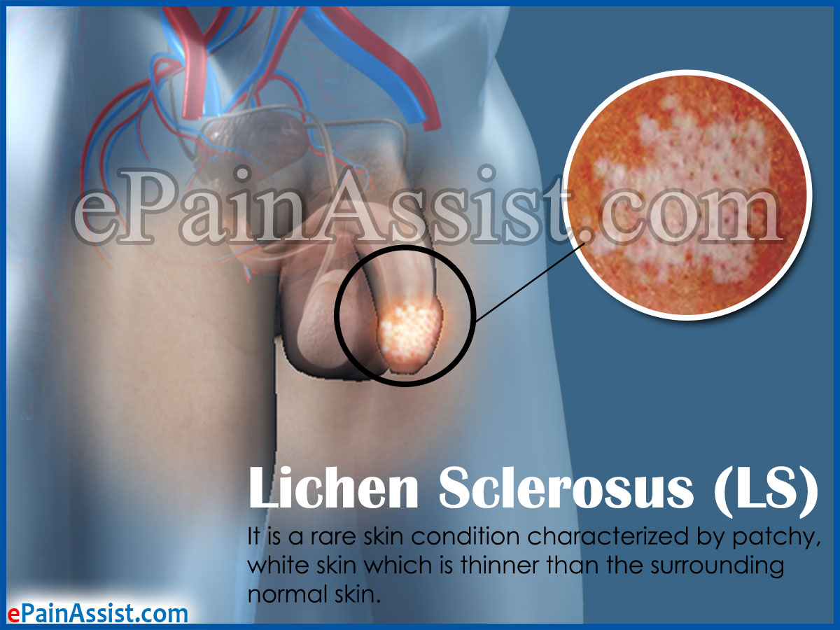 Lichen Sclerosus Lichen Sclerosus