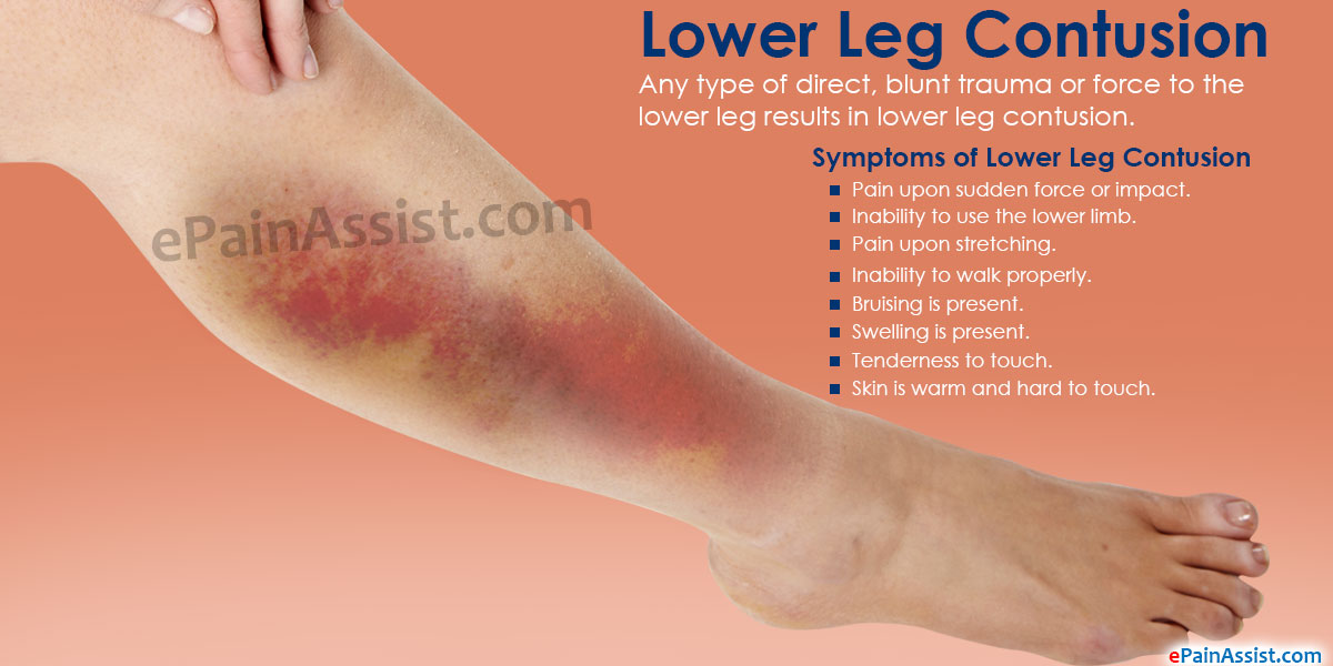 Lower Leg Contusion|Symptoms|Treatment|Stretching, Strengthening