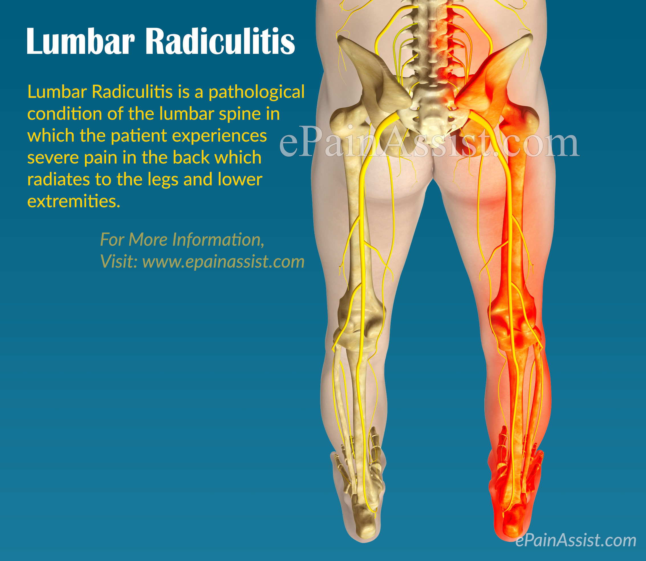 Lumbar Radiculitis