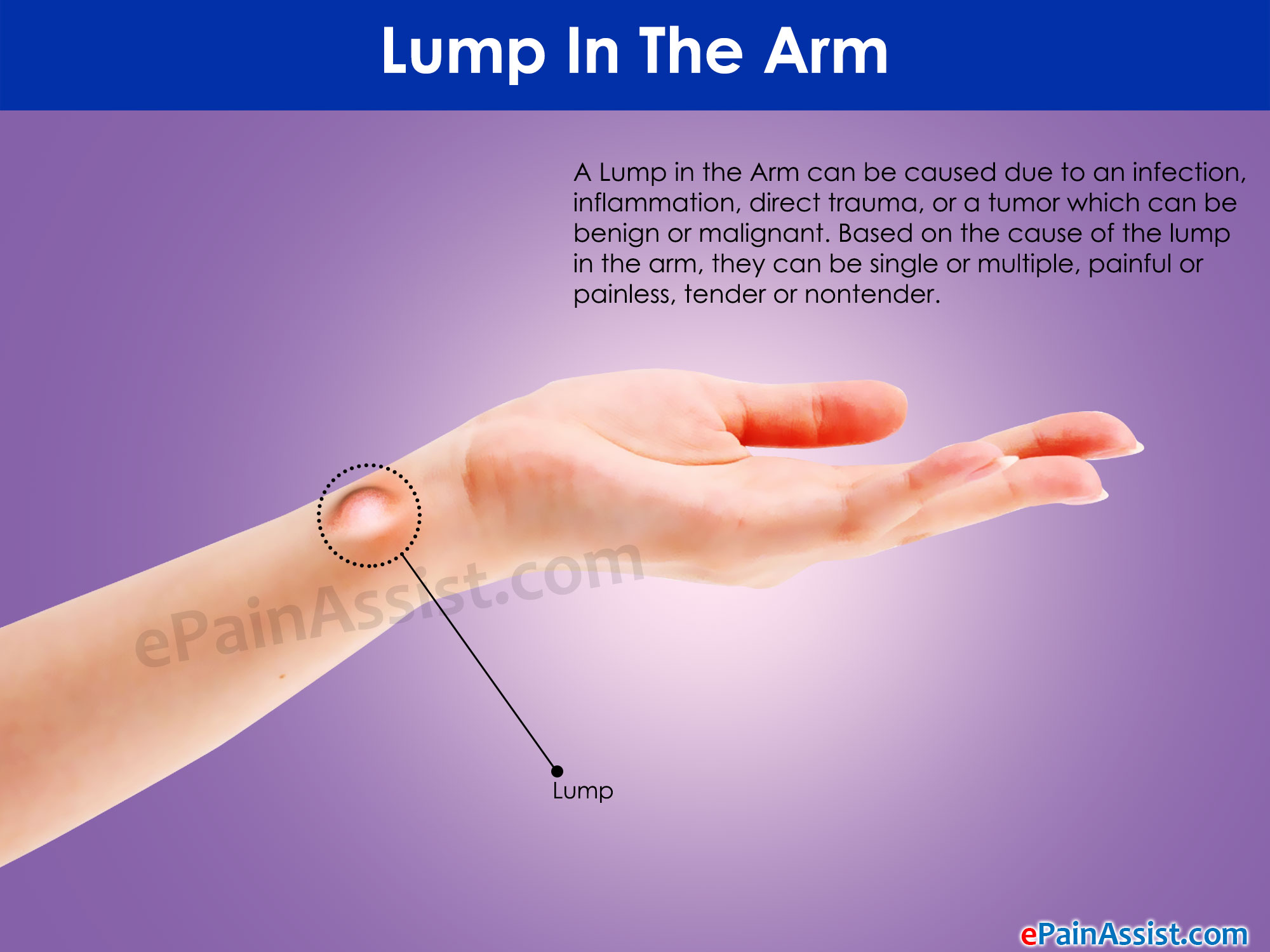 What are some causes of a lump in your wrist below your thumb?