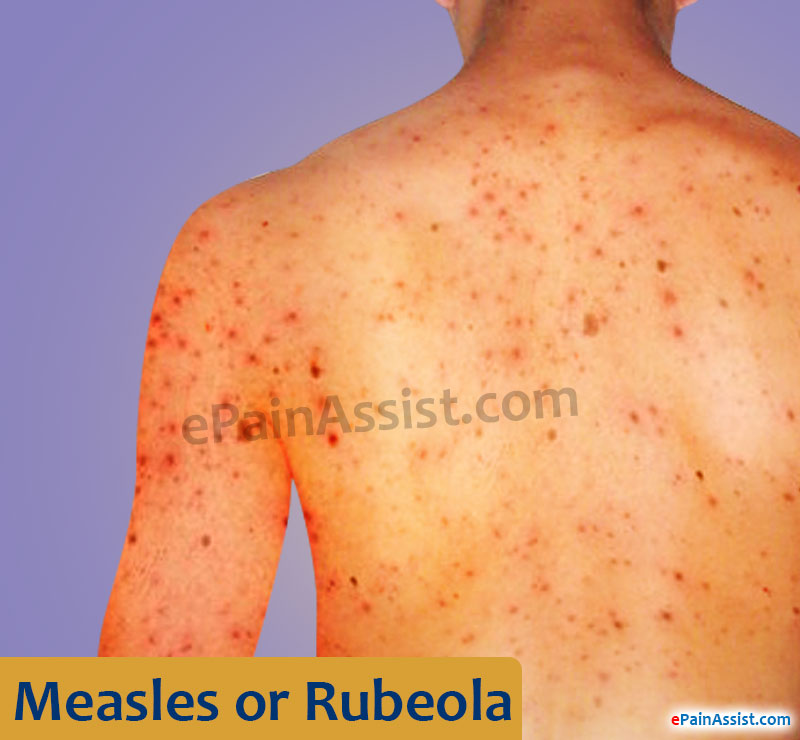 Measles or Rubeola