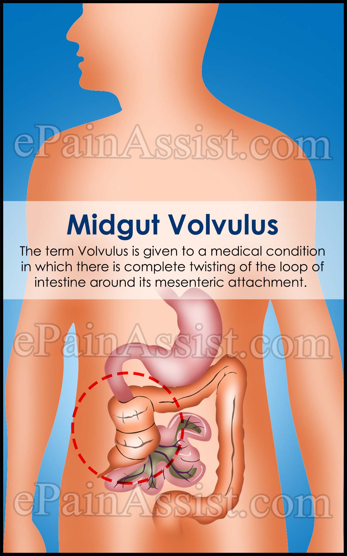 Midgut Volvulus Midgut Volvulus