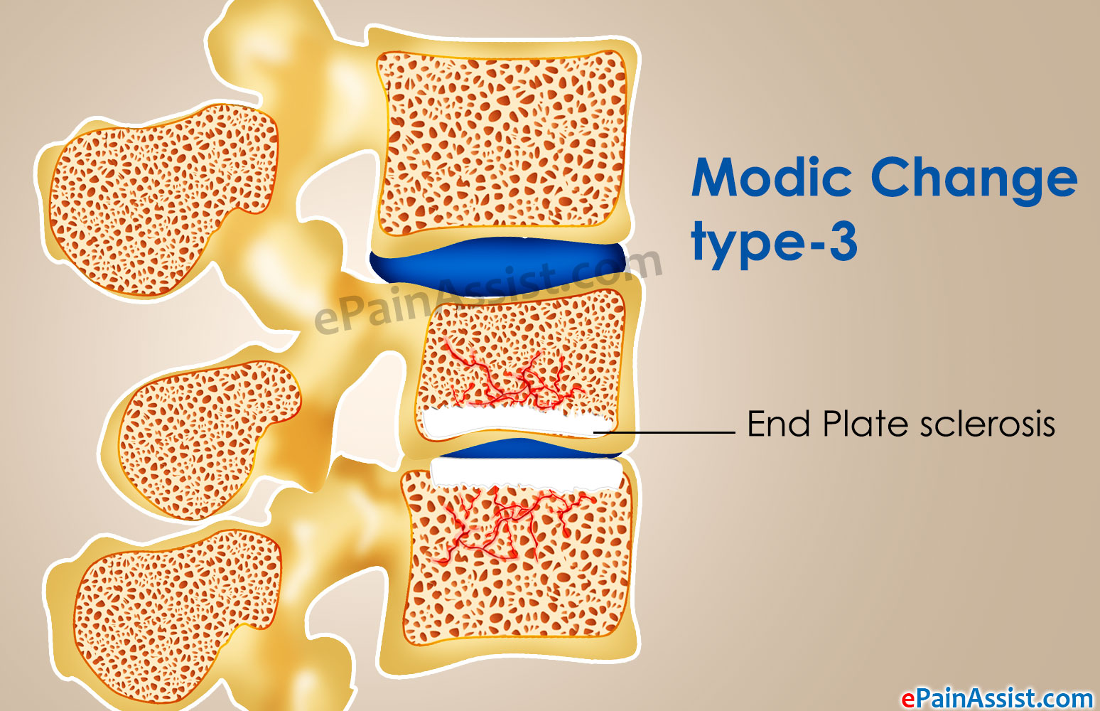 Modic Changes Type 3