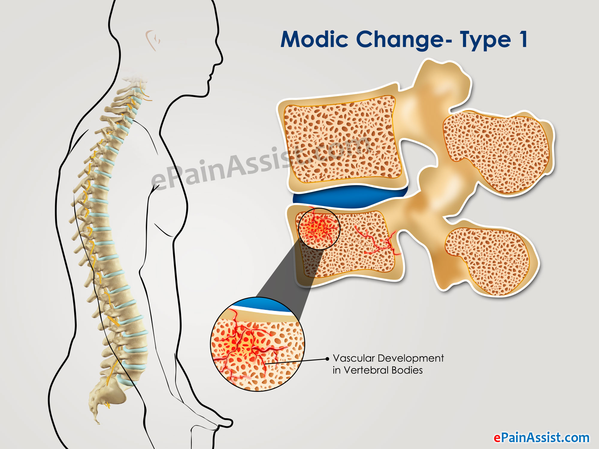 Modic Changes Type 1