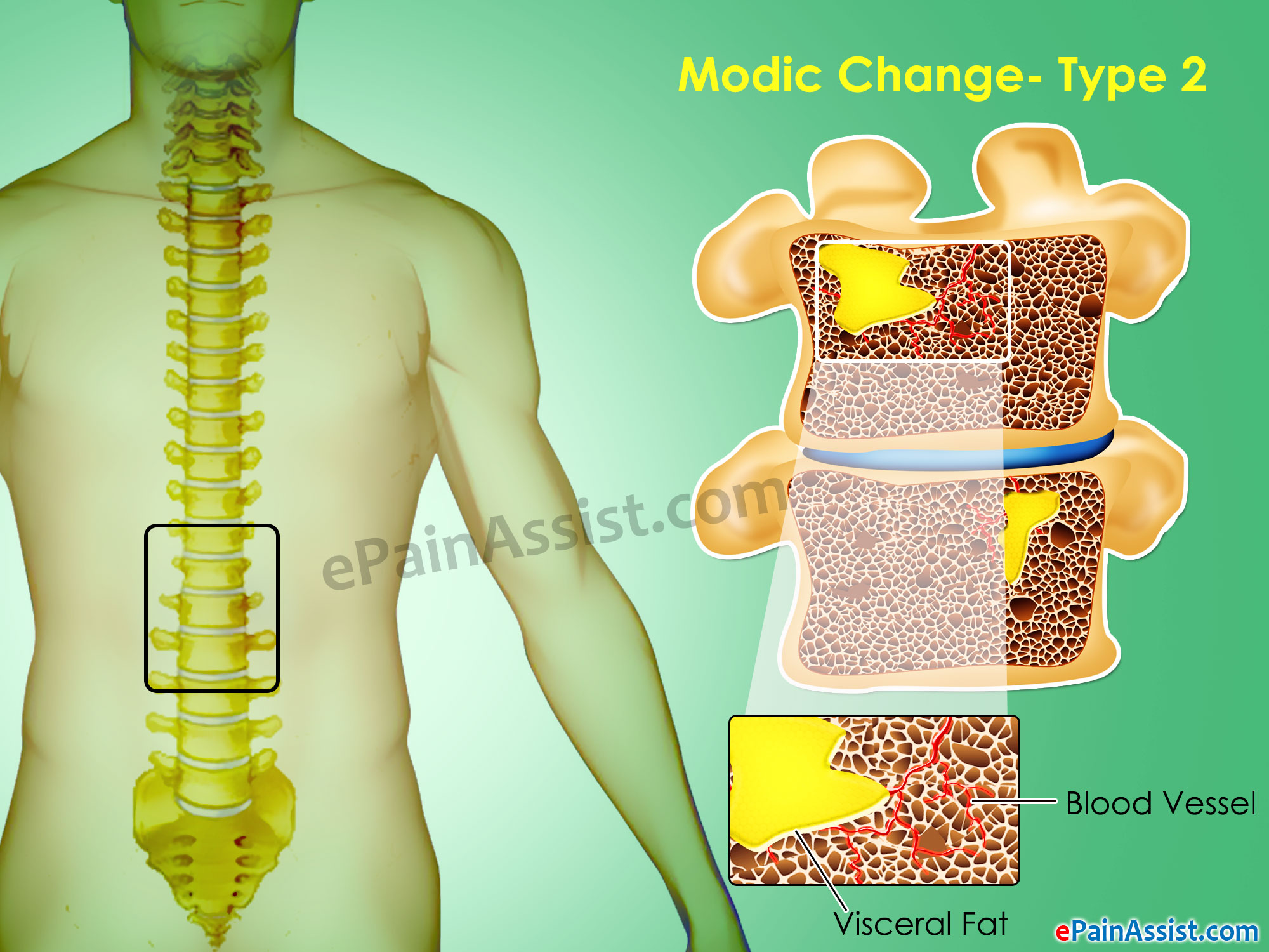 Modic Changes Type 2