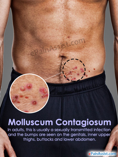 Molluscum Contagiosum Causes, Symptoms, Treatments