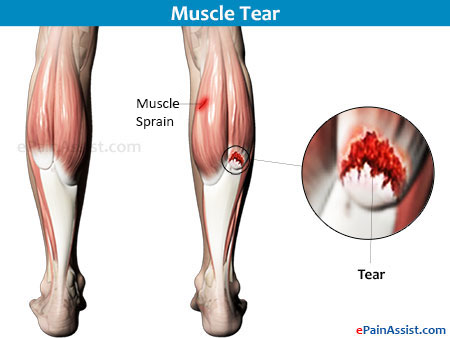 Partial Leg Pain Caused By Muscle Diseases