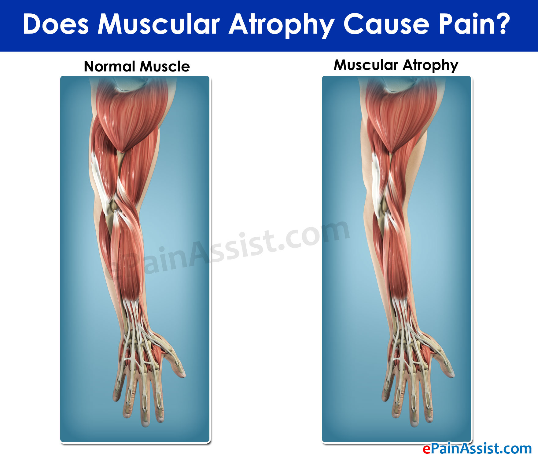 Muscular Atrophy