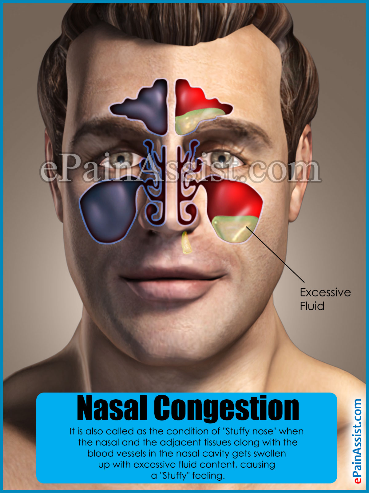 Nasal Congestion|Causes|Treatments|Home Remedies