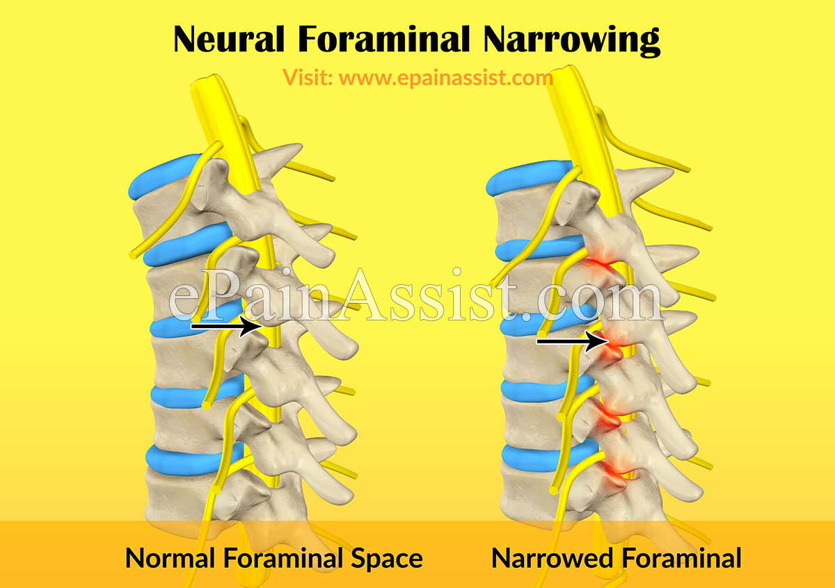 Neural Foraminal Narrowing Causes Symptoms Treatment Surgery