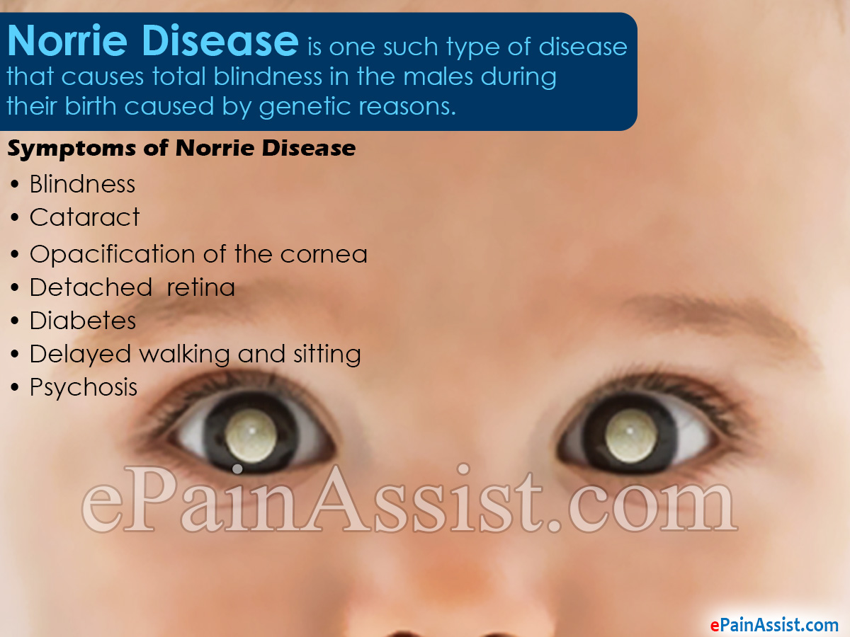 Norrie Disease Norrie Disease