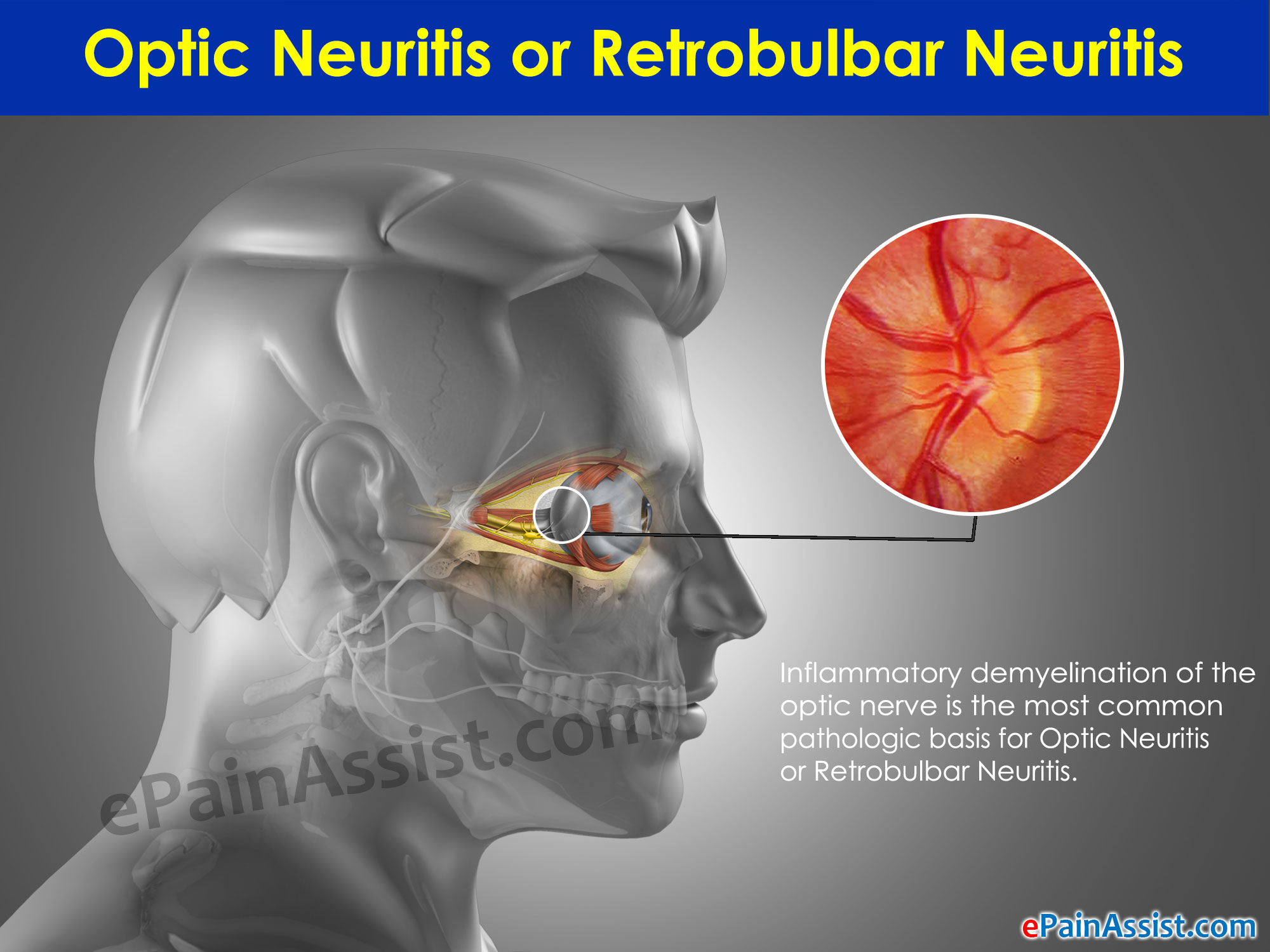 Herpes Viral Infections of the Eye: Treatment - MedicineNet