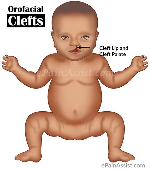 Cleft Lip and Cleft Palate (CLCP) or Orofacial Clefts Cleft Lip and Cleft Palate (CLCP) or Orofacial Clefts