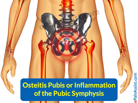 Osteitis Pubis or Inflammation of the Pubic Symphysis