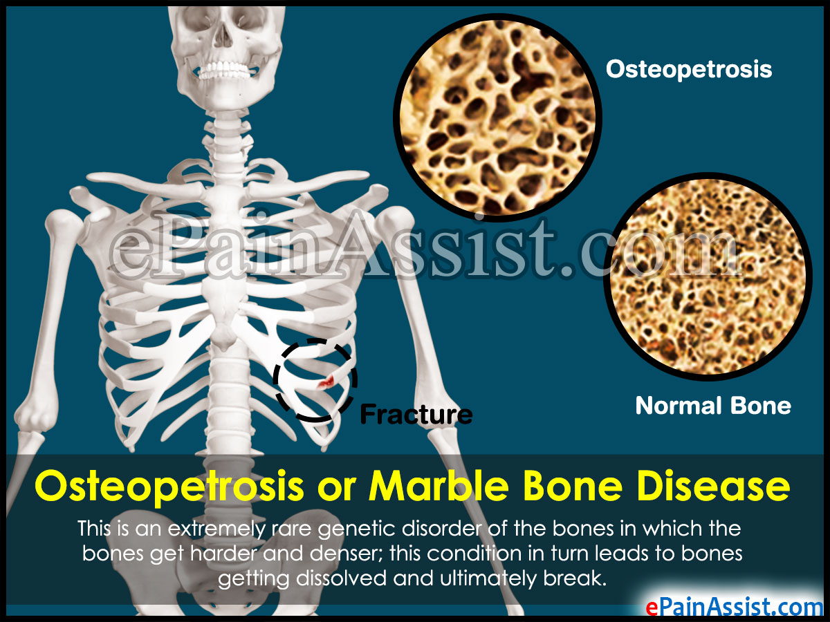 Osteopetrosis or Marble Bone Disease Osteopetrosis or Marble Bone Disease