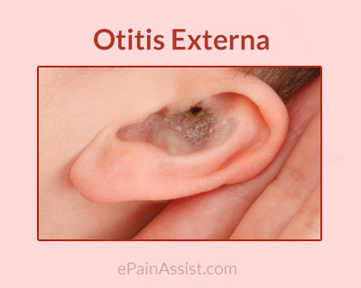 Otitis Externa or Swimmer’s Ear Otitis Externa or Swimmer’s Ear