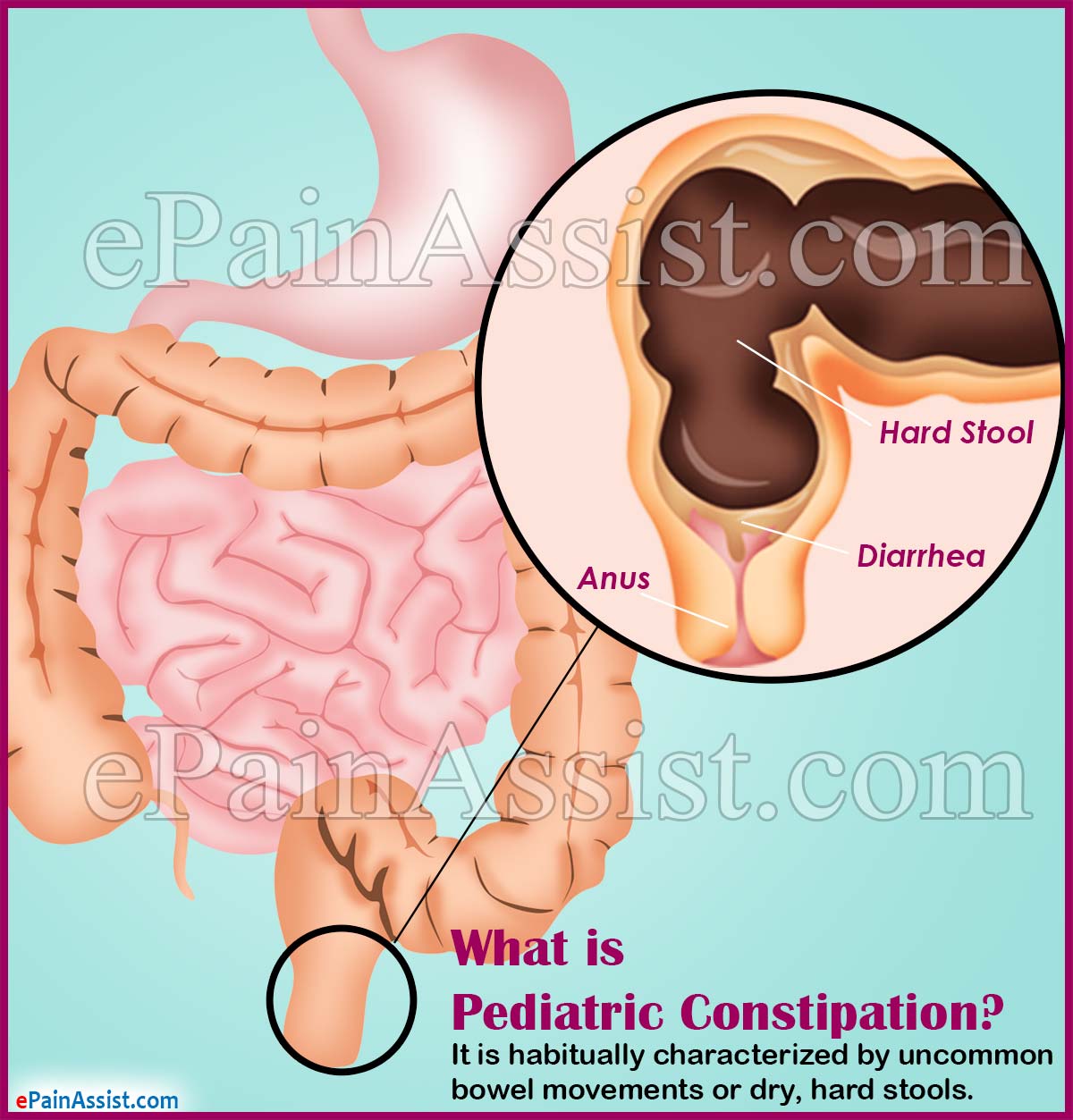 What is Pediatric Constipation What is Pediatric Constipation