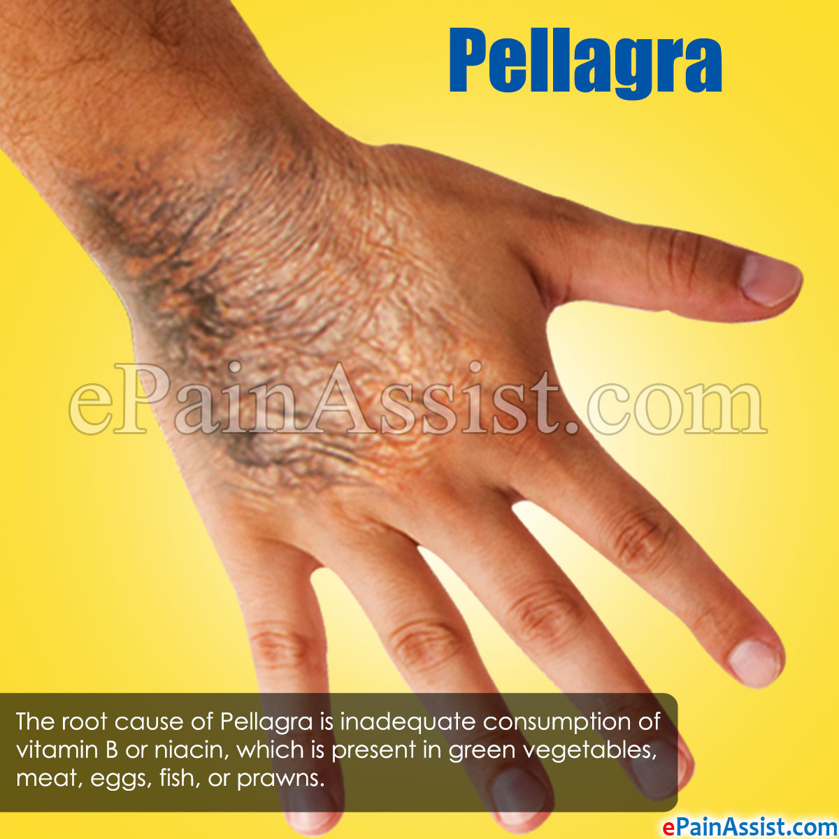 Pellagra Pellagra
