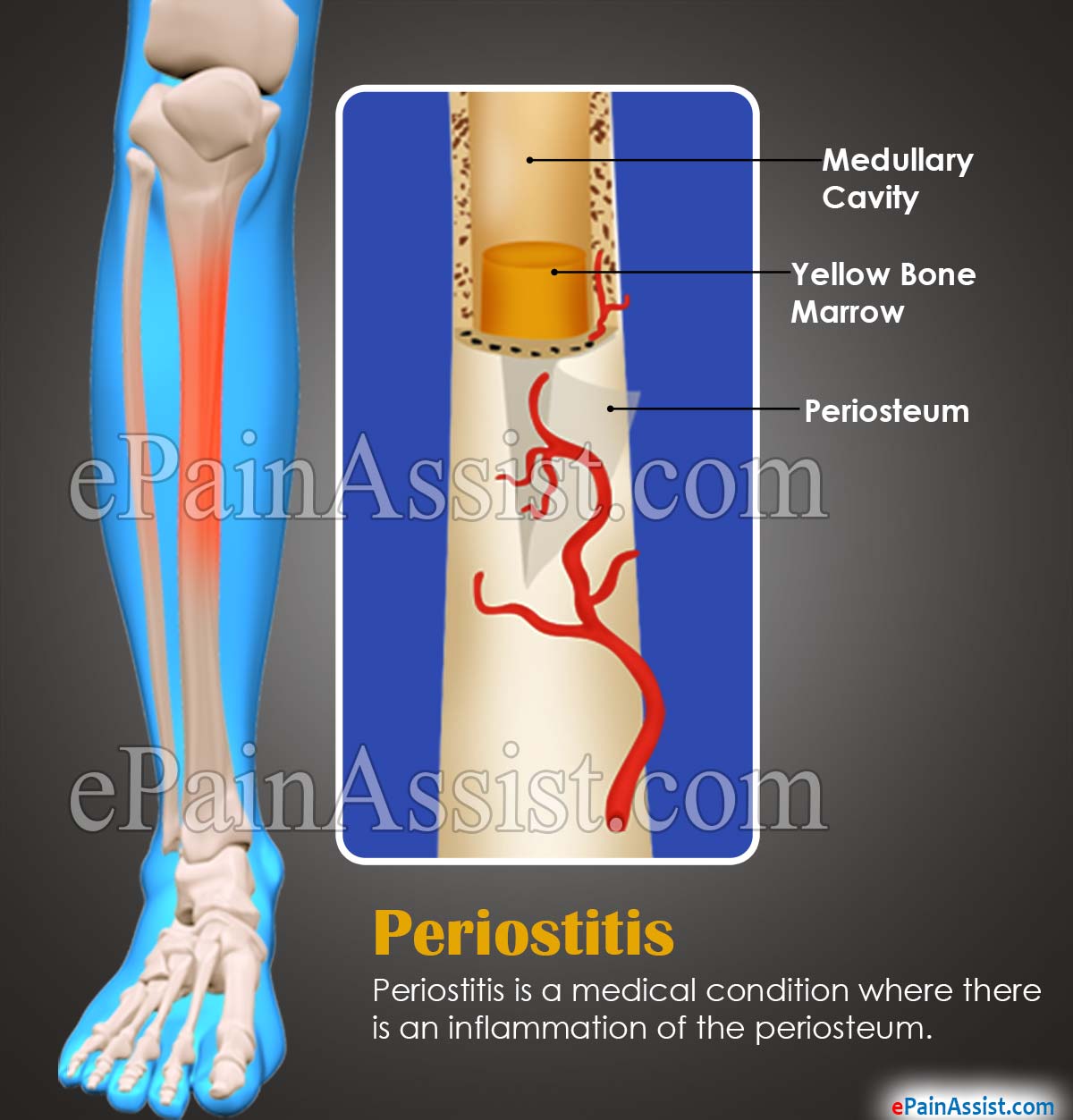 Overview on Periostitis Overview on Periostitis