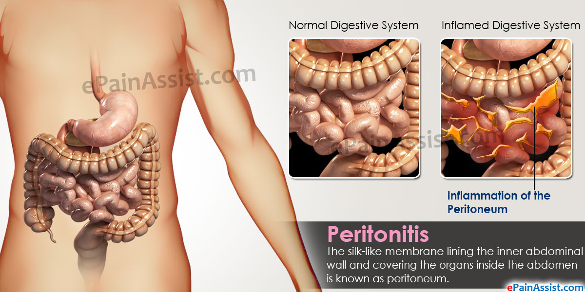 Acumulacion de liquido en el abdomen sintomas