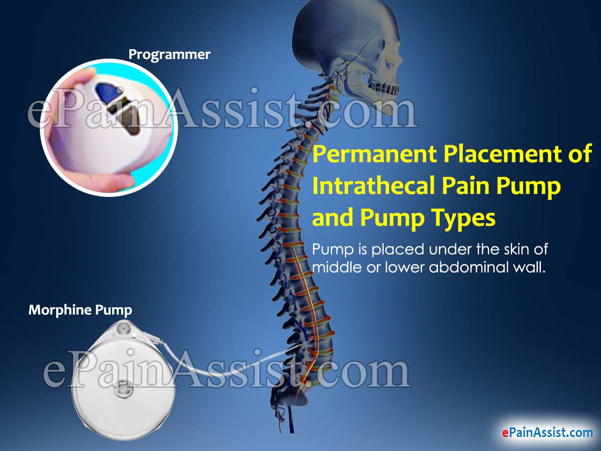 Permanent Placement of Intrathecal Pain Pump Permanent Placement of Intrathecal Pain Pump