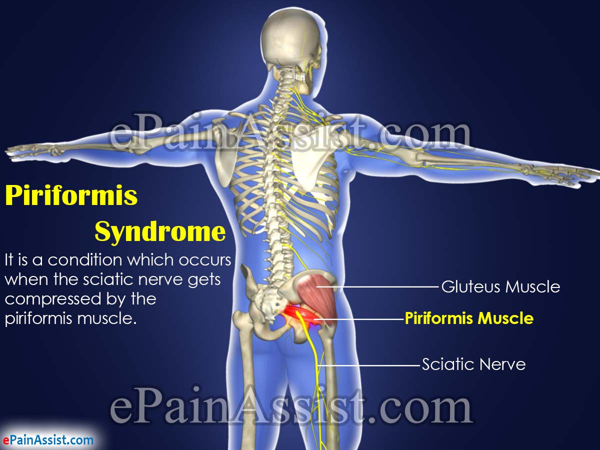 Piriformis Syndrome Piriformis Syndrome