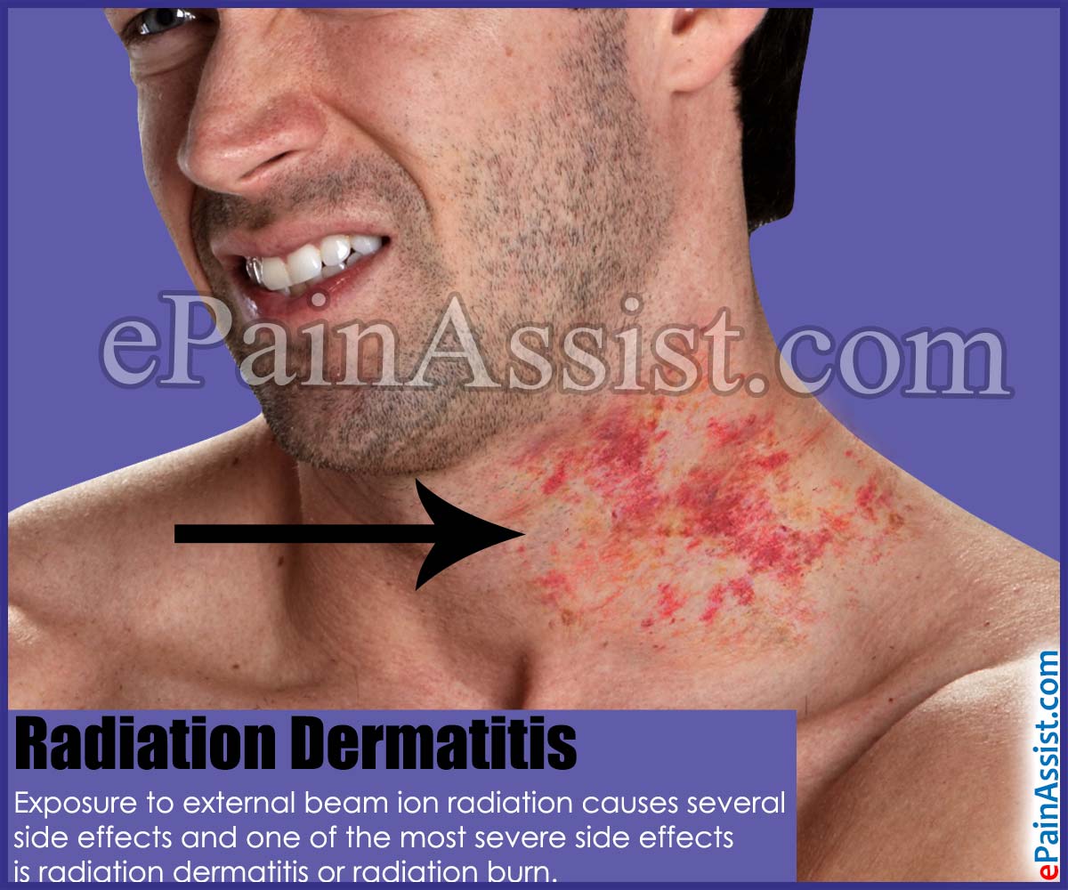 Radiation Dermatitis Radiation Dermatitis