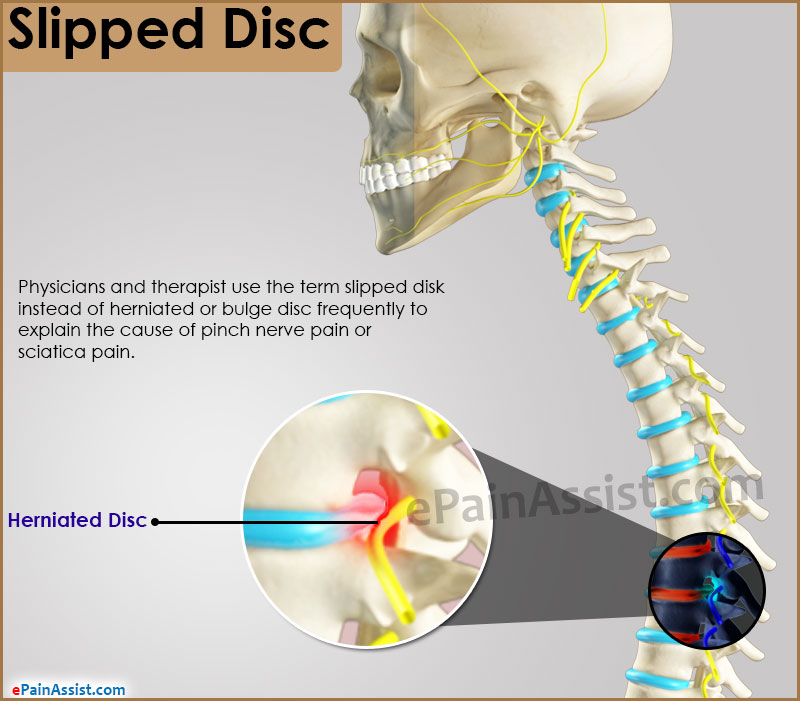 Slipped Disc