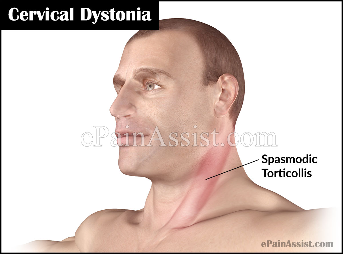 Spasmodic Torticollis Spasmodic Torticollis