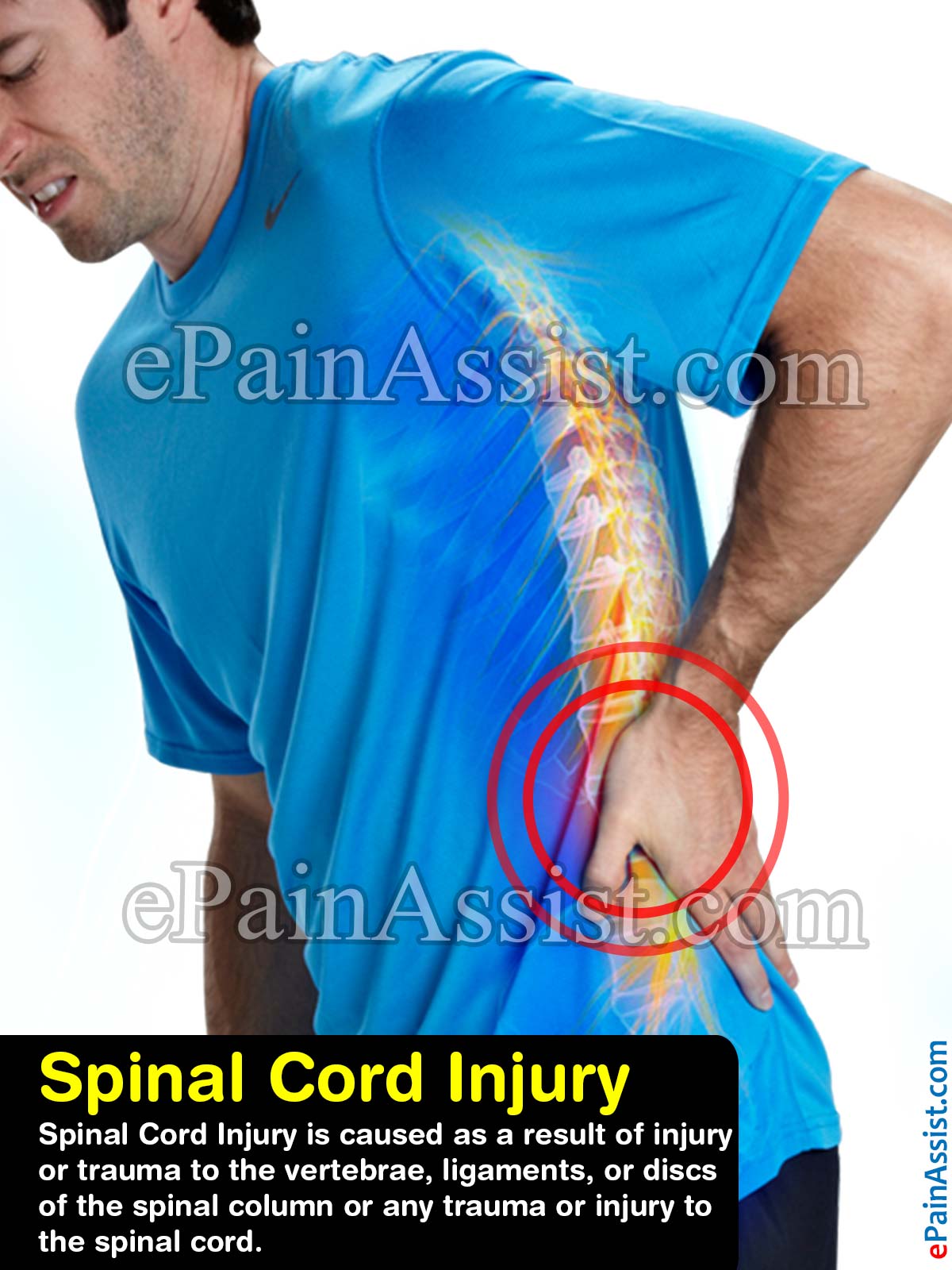 Spinal Cord Injury Spinal Cord Injury