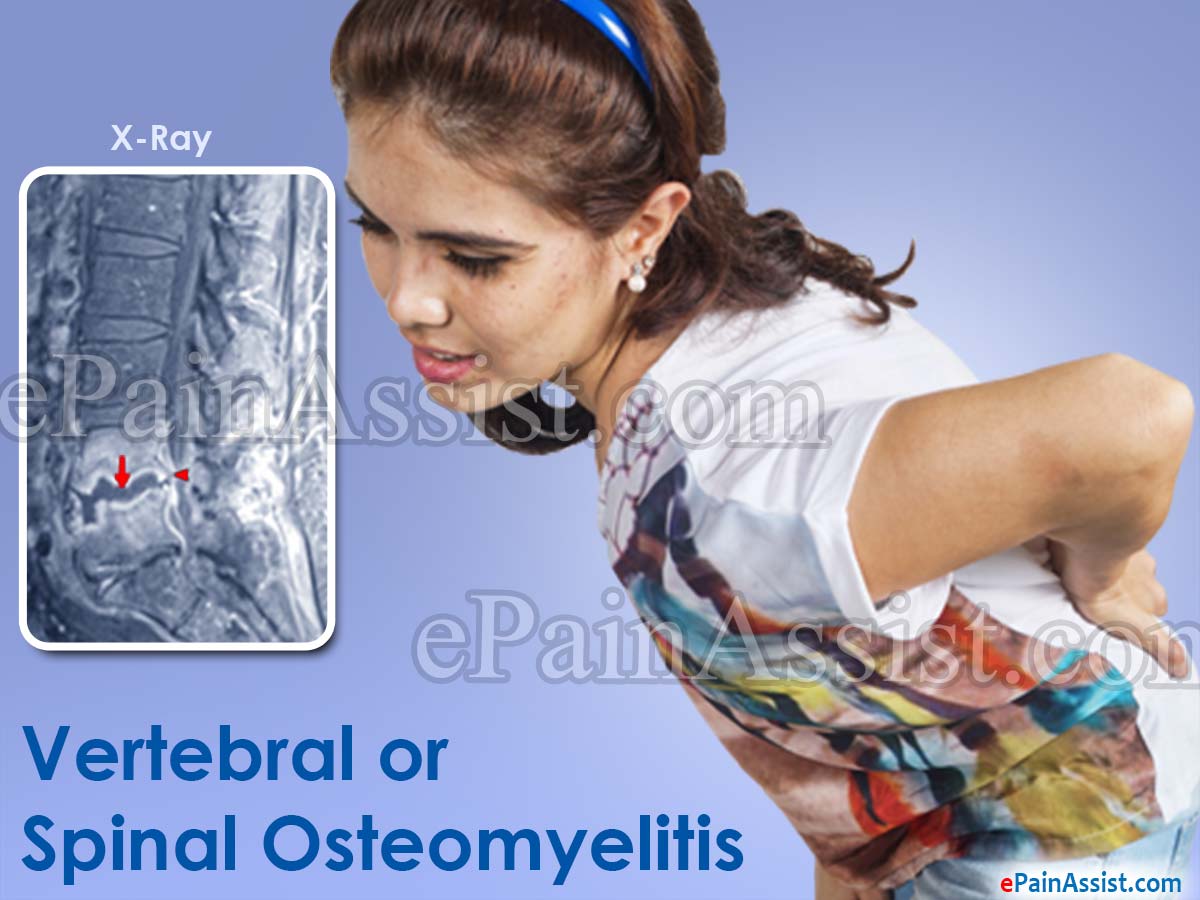 Vertebral or Spinal Osteomyelitis Vertebral or Spinal Osteomyelitis