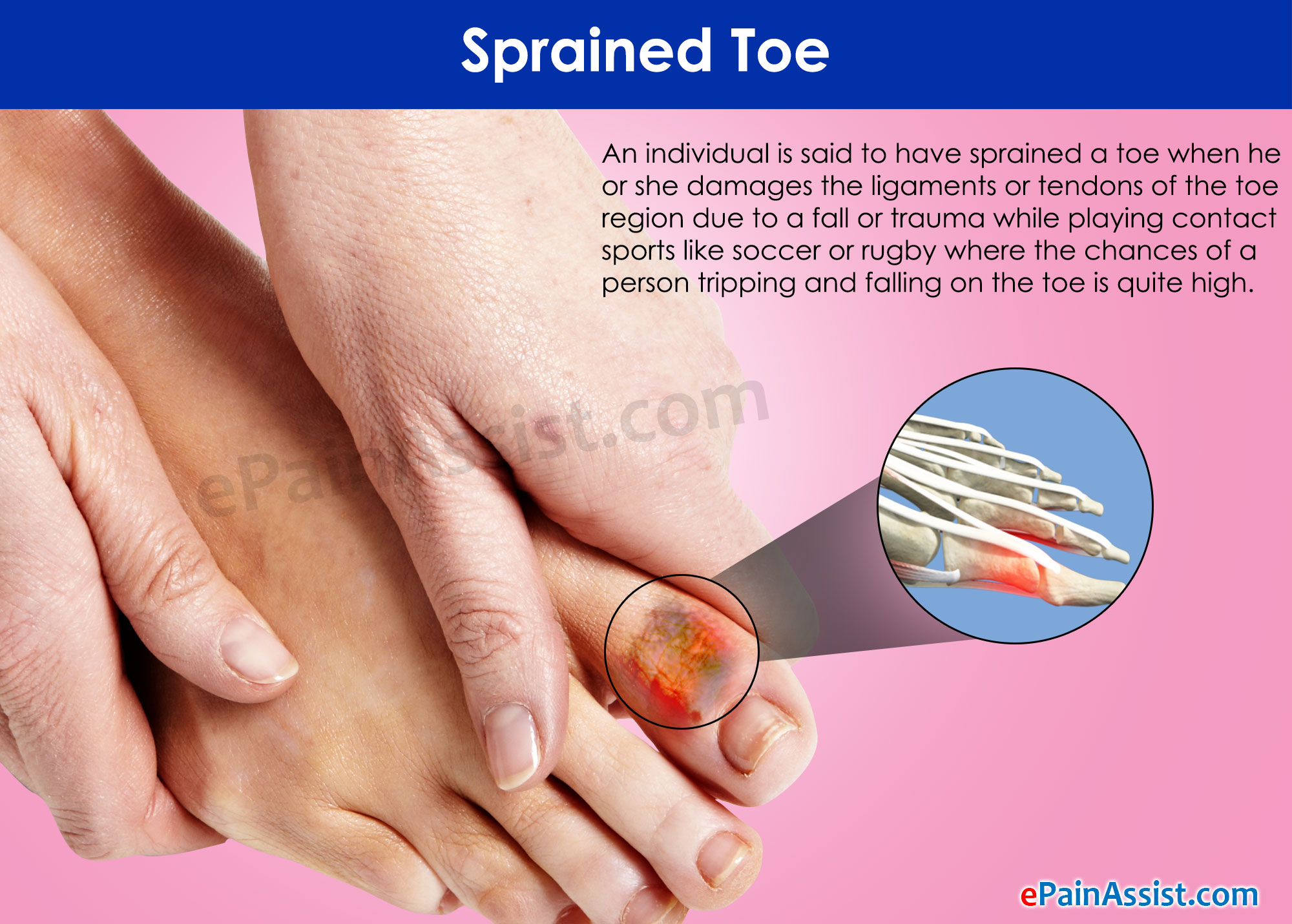How To Help A Sprained Toe Warselection