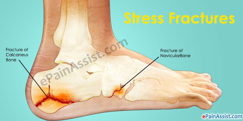 Lateral Foot Pain or Pain on the Outer Side of the Foot!