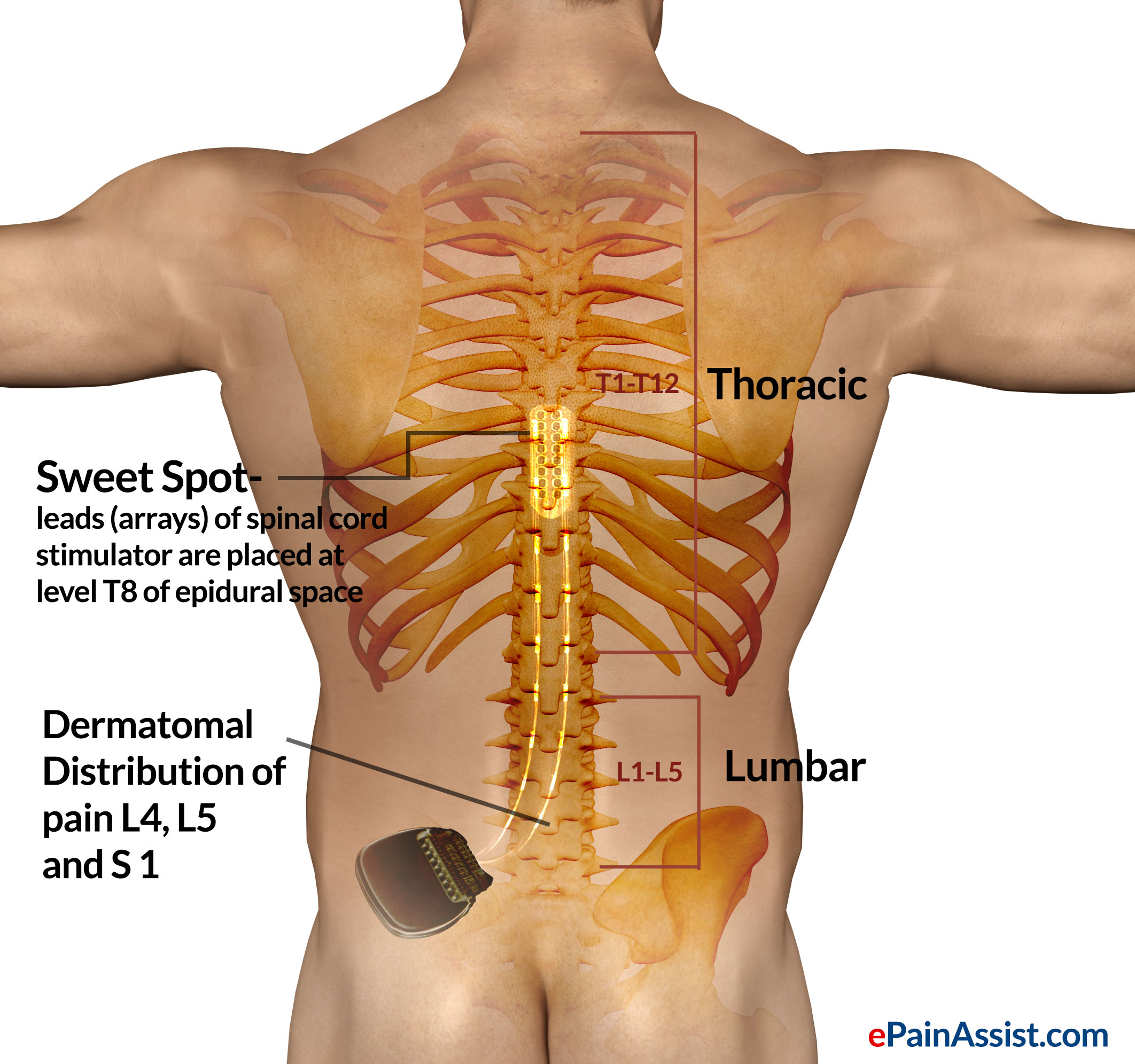 Spinal Cord Stimulator-Sweet Spot Spinal Cord Stimulator-Sweet Spot