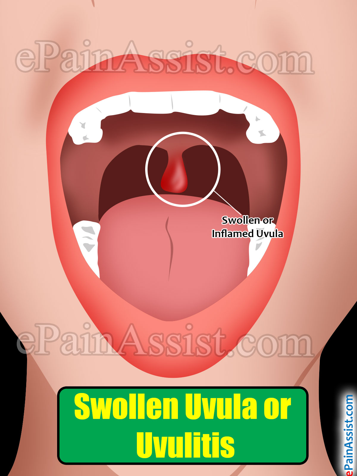 Swollen Uvula or Uvulitis