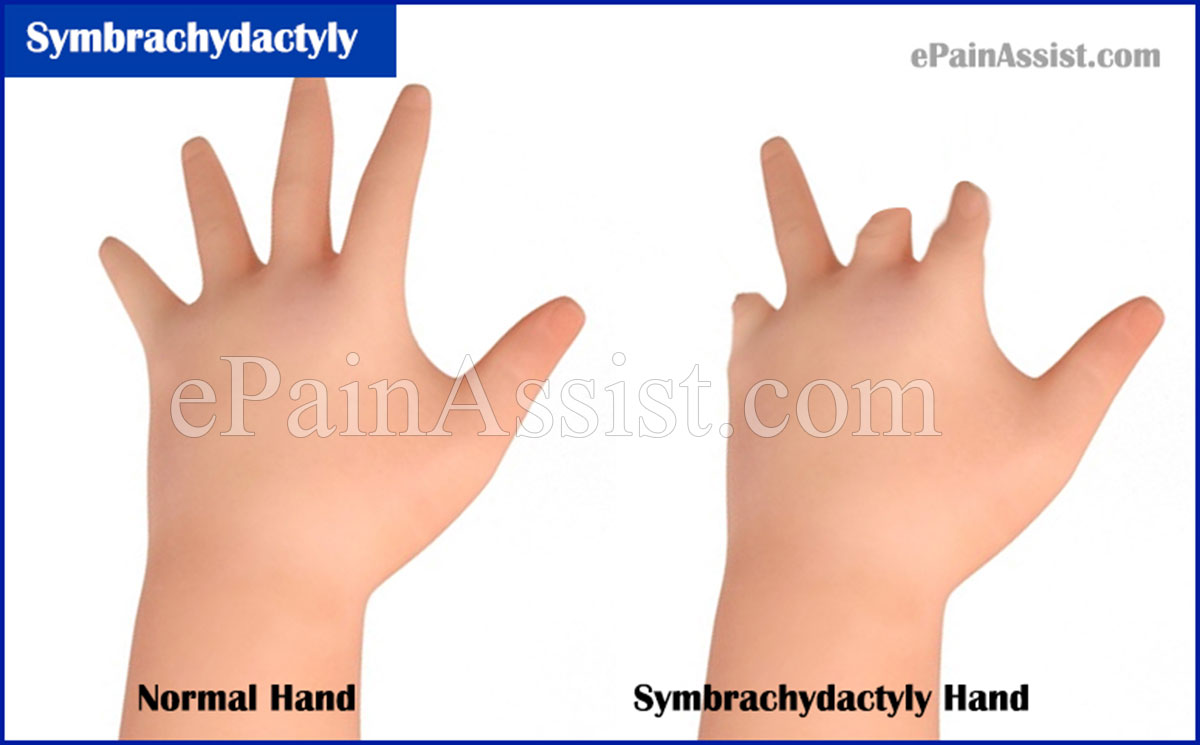 Symbrachydactyly