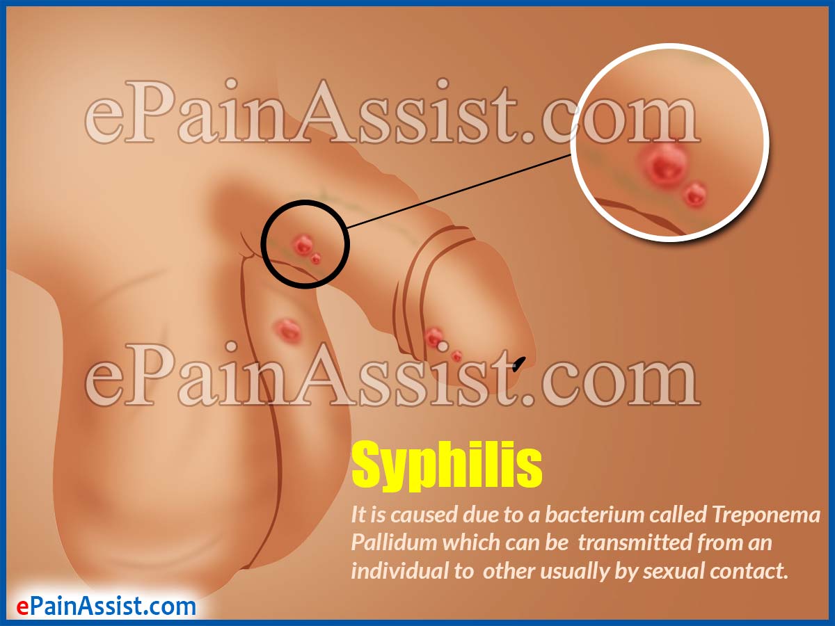 What Is Syphilis What Is Syphilis