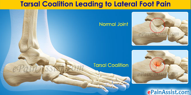 Tarsal Coalition Leading to Lateral Foot Pain