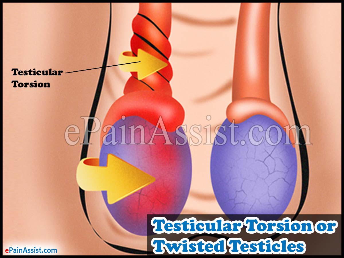 Testicular Torsion or Twisted Testicles