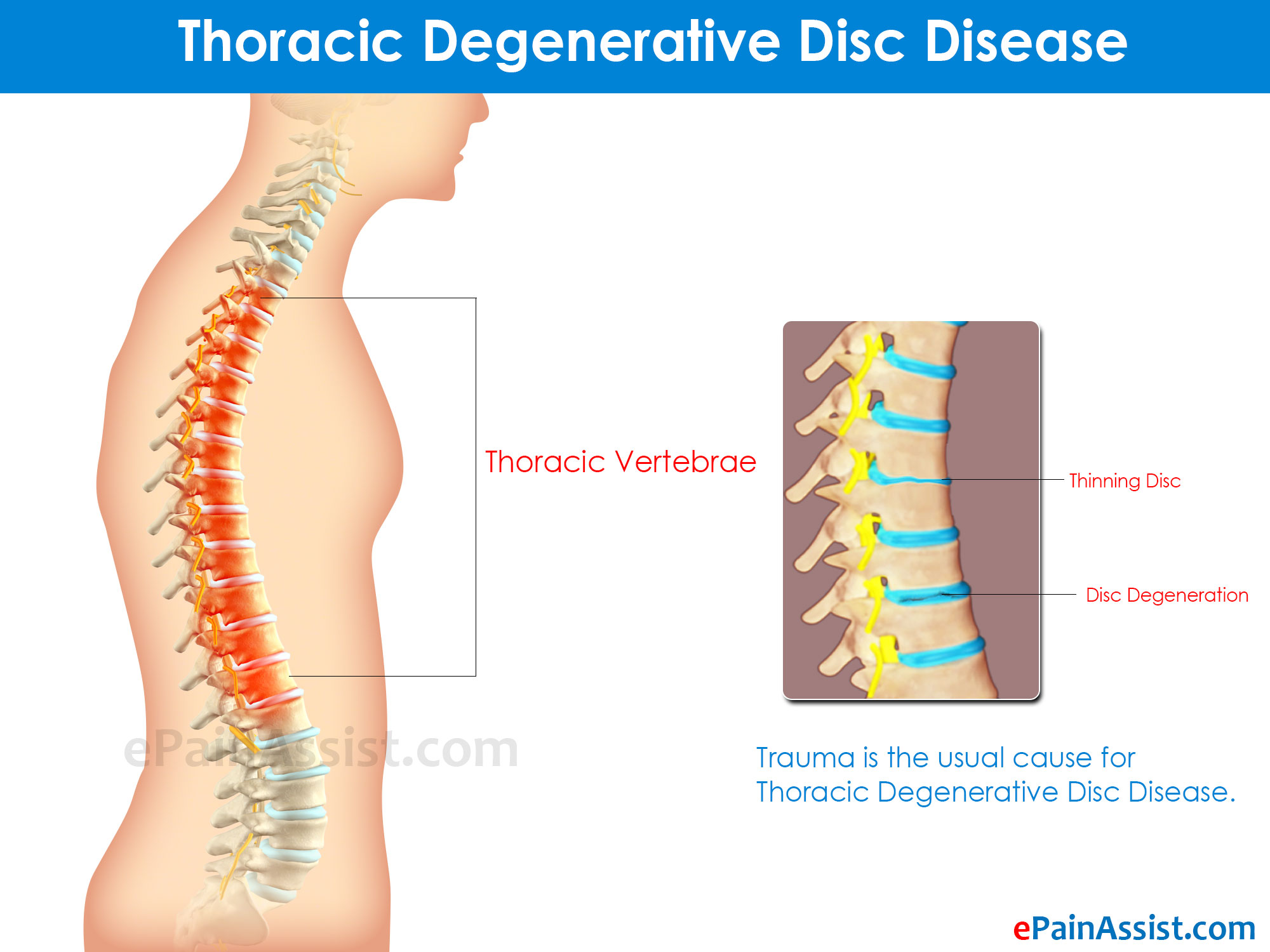 Thoracic Degenerative Disc Disease