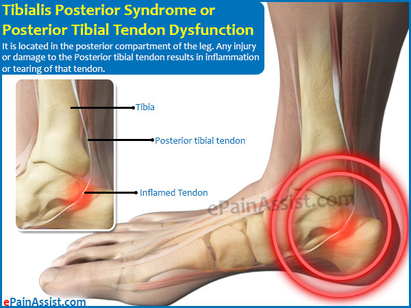 Tibialis Posterior Syndrome or Posterior Tibial Tendon Dysfunction