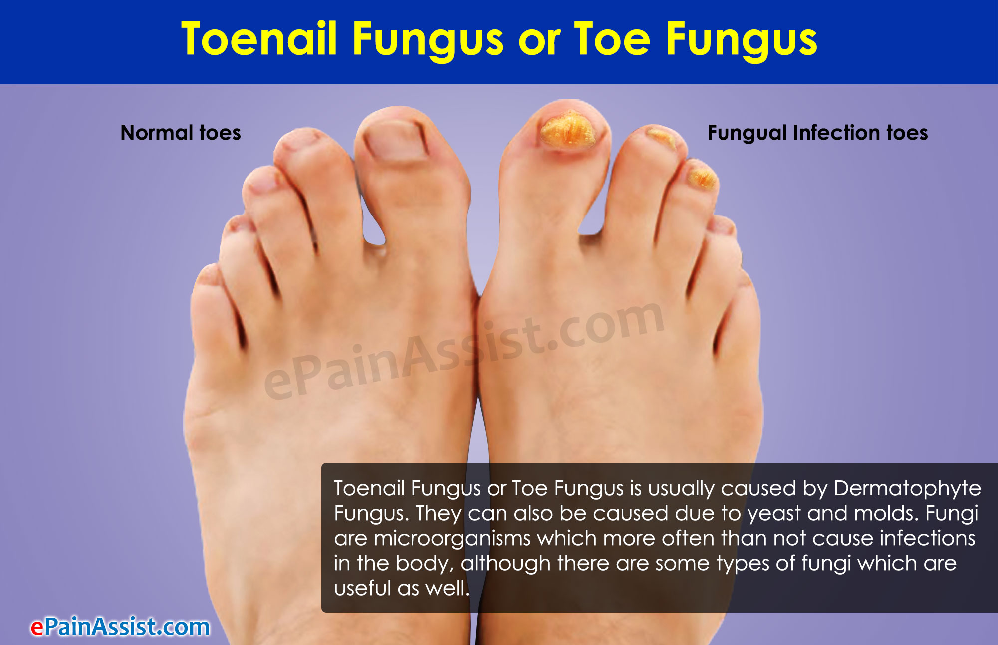 Ringworm Tinea Unguium (Onychomycosis) Picture Image on ...