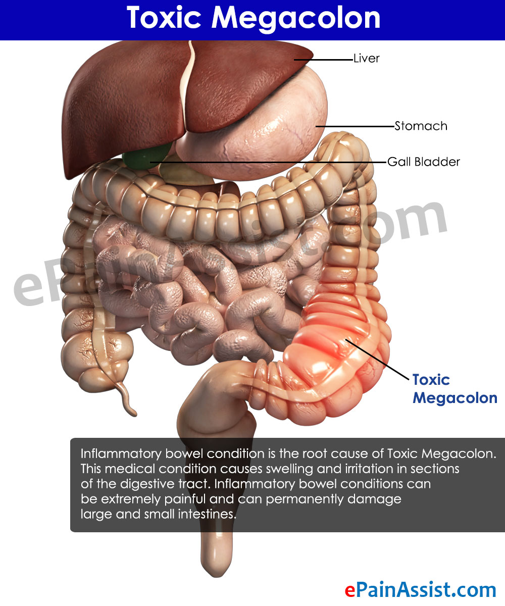 Toxic MegacolonTreatmentPrognosisCausesSymptomsDiagnosis